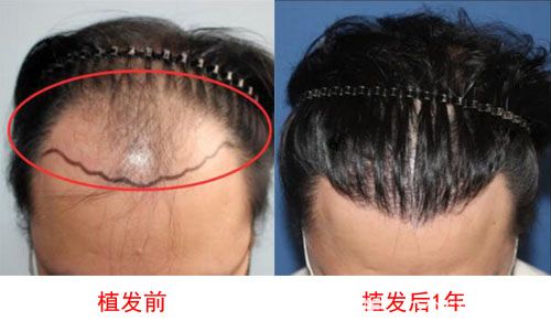 韓國毛杰琳植發(fā)術(shù)前與術(shù)后效果對比圖 韓國毛杰琳植發(fā)術(shù)前與術(shù)后效果對比圖