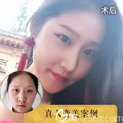 深圳潤澤瑞尼絲陳敬武院長隆鼻案例