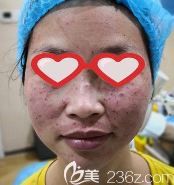 找呼市大韓整形陳琳醫(yī)生激光祛斑即刻效果