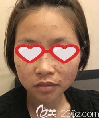 激光祛斑第二天圖片