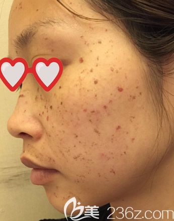 皮秒激光祛斑第三天臉有點(diǎn)癢