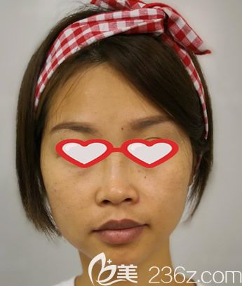 皮秒祛斑10天變化圖片