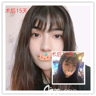 孝感天妃醫(yī)美柳肖主任眼綜合術(shù)后10天-15天恢復(fù)照片 孝感天妃醫(yī)美柳肖主任眼綜合術(shù)后10天-15天恢復(fù)照片