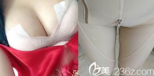 在長春中妍整形做隆胸和吸脂術(shù)后一周