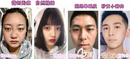 全切雙眼皮案例