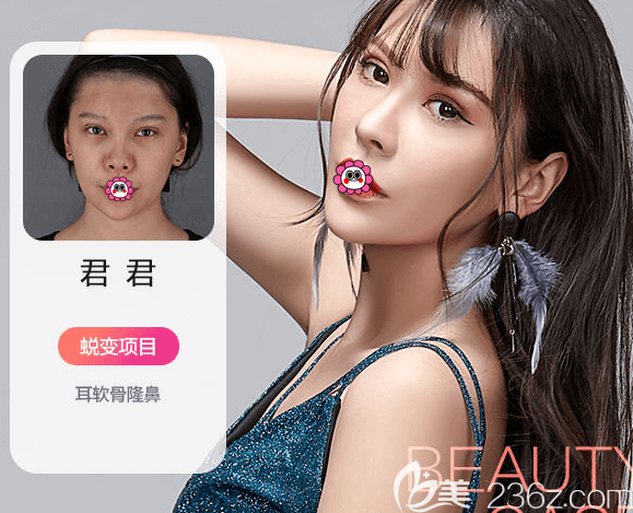 北京米蘭柏羽麗都耳軟骨隆鼻案例