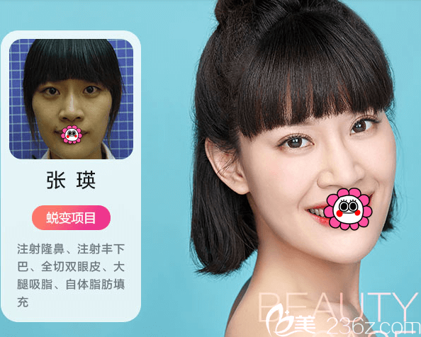 北京米蘭柏羽麗都注射隆鼻及豐下巴+雙眼皮+大腿吸脂+面部脂肪填充案例