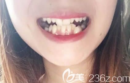 我做矯正前牙齒深覆頜的樣子 我做矯正前牙齒深覆頜的樣子