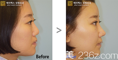 韓國愛佩思鼻綜合隆鼻案例效果前后對比 韓國愛佩思鼻綜合隆鼻案例效果前后對比