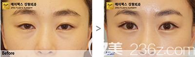 韓國愛佩思眼部綜合整形案例效果對比圖 韓國愛佩思眼部綜合整形案例效果對比圖