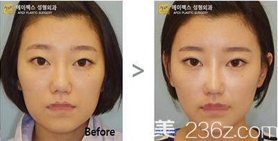 韓國愛佩思自體脂肪面部填充案例 韓國愛佩思自體脂肪面部填充案例