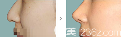 韓國(guó)愛(ài)佩思APEX整形外科宋鉉錫院長(zhǎng)鼻部整形案例效果對(duì)比圖 韓國(guó)愛(ài)佩思APEX整形外科宋鉉錫院長(zhǎng)鼻部整形案例效果對(duì)比圖