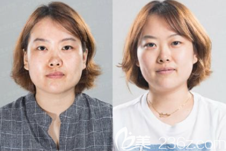 貴陽(yáng)美萊4C鉆石嬰兒肌案例