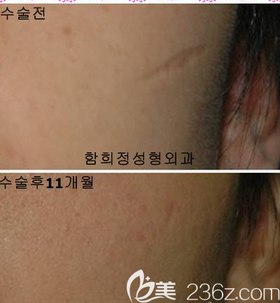 韓國(guó)dr.ham's疤痕醫(yī)院案例