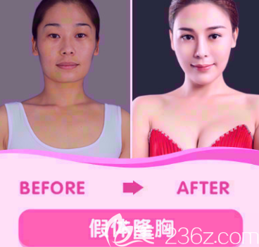 榆林博愛整形醫(yī)院假體隆胸案例二