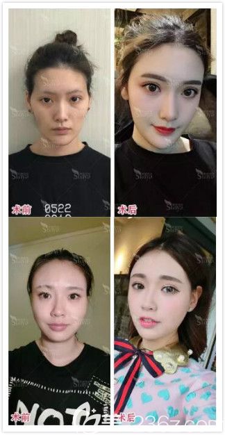 長沙星雅整形自體脂肪填充面部真人前后效果對(duì)比圖
