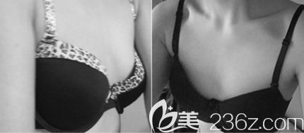 在韓國TL整形醫(yī)院做隆胸手術(shù)前 在韓國TL整形醫(yī)院做隆胸手術(shù)前