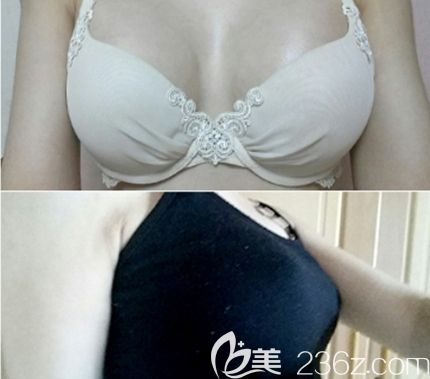 在韓國TL整形醫(yī)院做隆胸手術(shù)后1個(gè)月 在韓國TL整形醫(yī)院做隆胸手術(shù)后1個(gè)月