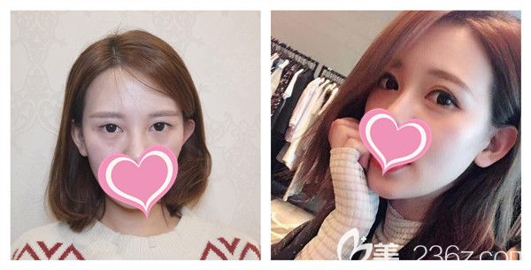 孝感天妃<!--<i data=20240703-sp></i>-->博士切開(kāi)雙眼皮+開(kāi)眼角打造芭比電眼術(shù)后對(duì)比圖