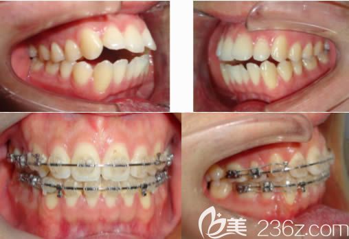 莫媛媛醫(yī)生牙齒開合矯正案例效果圖