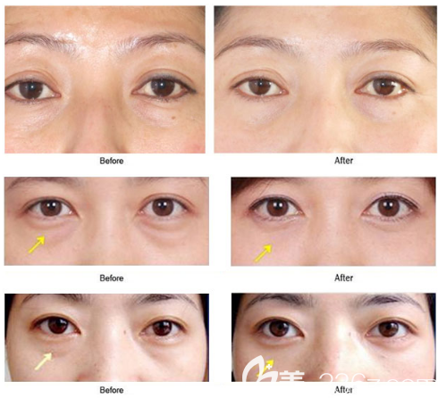 佛山曙光金子甘國端院長三分鐘急速祛眼袋案例