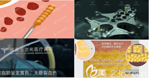 北京潤(rùn)美玉之光王明利醫(yī)生吸脂提純等相關(guān)信息示意圖