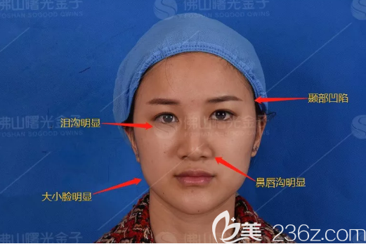 在佛山曙光金子做線雕術(shù)前照片 在佛山曙光金子做線雕術(shù)前照片