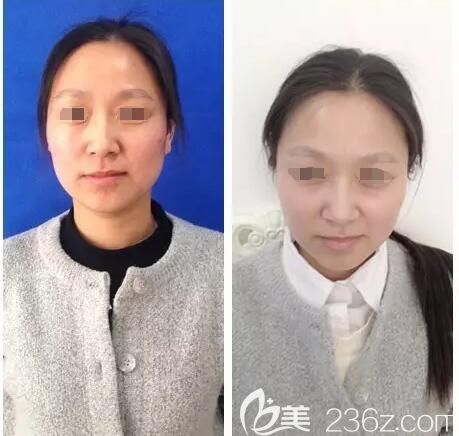 到淮安華美做前后對(duì)比案例