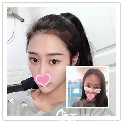 激光祛眼袋+自體脂肪豐臥蠶術(shù)后1-10天圖片 激光祛眼袋+自體脂肪豐臥蠶術(shù)后1-10天圖片