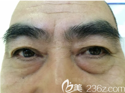 在佛山曙光金子做祛眼袋術(shù)前照片 在佛山曙光金子做祛眼袋術(shù)前照片