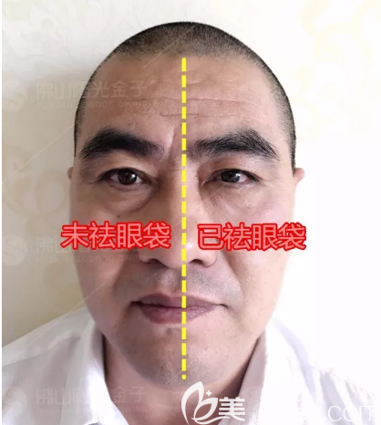 佛山曙光金子甘國(guó)端院長(zhǎng)祛眼袋案例對(duì)比圖 佛山曙光金子甘國(guó)端院長(zhǎng)祛眼袋案例對(duì)比圖