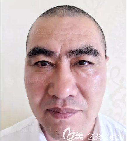 說說我花6800元去佛山曙光金子找甘國端院長做3分鐘極速祛眼袋的親身經(jīng)歷和感受