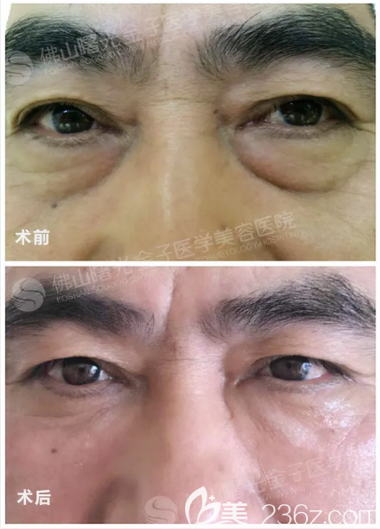 佛山曙光金子甘國(guó)端院長(zhǎng)祛眼袋價(jià)格6800元 佛山曙光金子甘國(guó)端院長(zhǎng)祛眼袋價(jià)格6800元