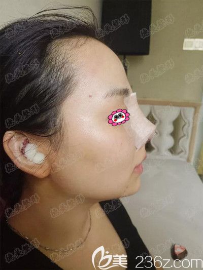 剛做完手術(shù)后的樣子