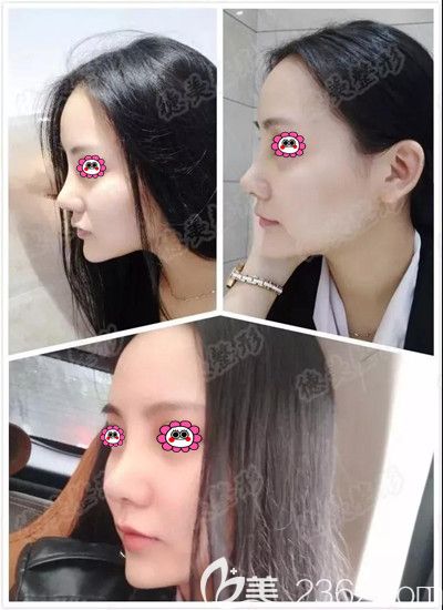 鼻綜合術(shù)后第七天拆線后的照片