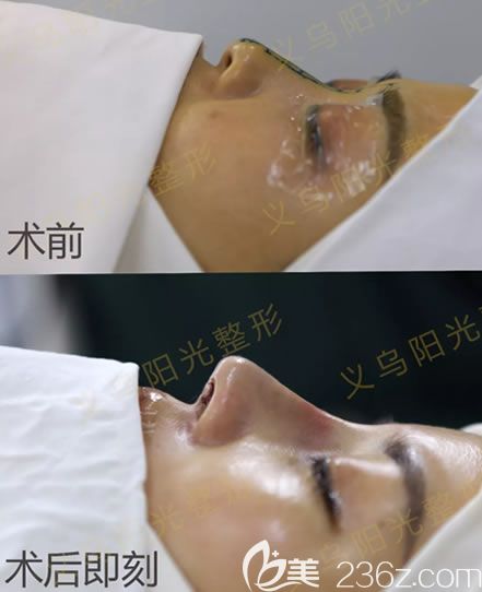 義烏陽光整形醫(yī)院肋骨鼻即刻<span style=