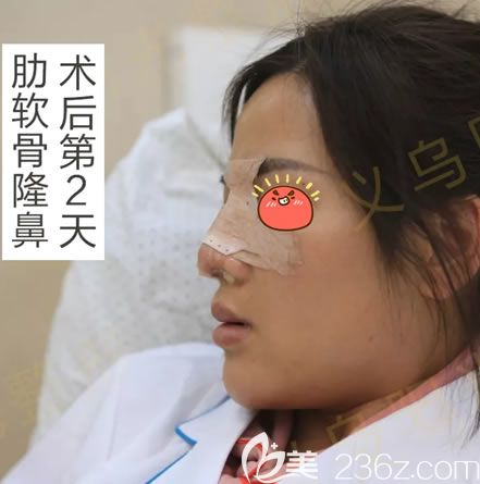 義烏陽光肋骨鼻<span style=