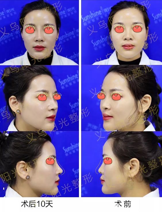 義烏陽光肋軟骨鼻綜合<span style=