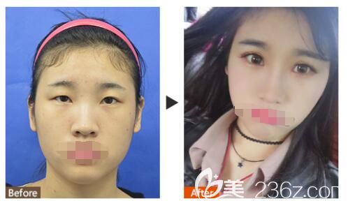 張成春醫(yī)生眼綜合案例 張成春醫(yī)生眼綜合案例