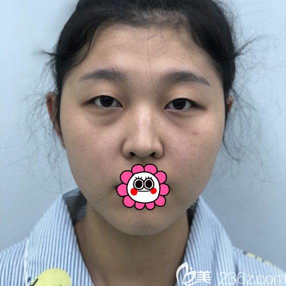 沒做雙眼皮前的我 沒做雙眼皮前的我