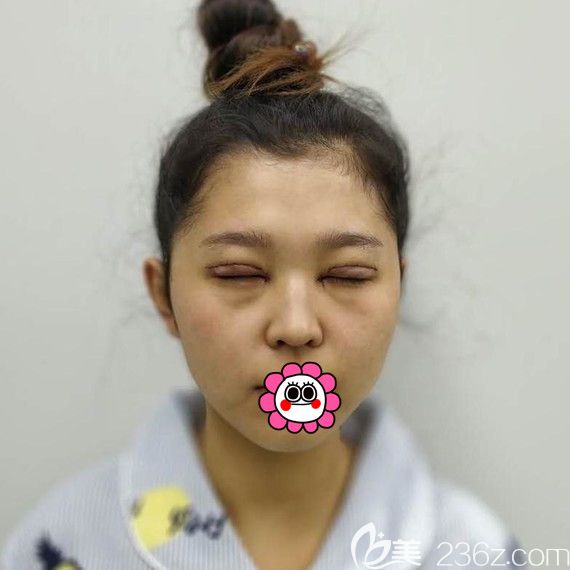 雙眼皮手術后即刻效果 雙眼皮手術后即刻效果