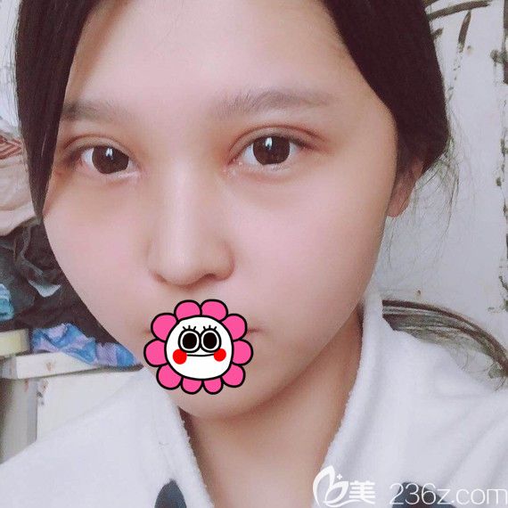 哈爾濱索菲雙眼皮半個月效果 哈爾濱索菲雙眼皮半個月效果