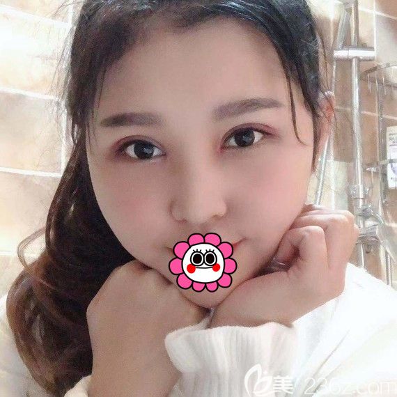 哈爾濱索菲呂松岸雙眼皮恢復一個月效果 哈爾濱索菲呂松岸雙眼皮恢復一個月效果