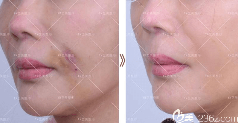 北京藝美王東面部脂肪移植失敗修復(fù)案例 北京藝美王東面部脂肪移植失敗修復(fù)案例