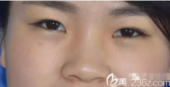 面診淮安華美術(shù)前塌鼻子 面診淮安華美術(shù)前塌鼻子