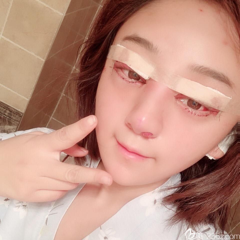 合肥白領(lǐng)安琪兒眼綜合+鼻綜合術(shù)后當(dāng)天 合肥白領(lǐng)安琪兒眼綜合+鼻綜合術(shù)后當(dāng)天