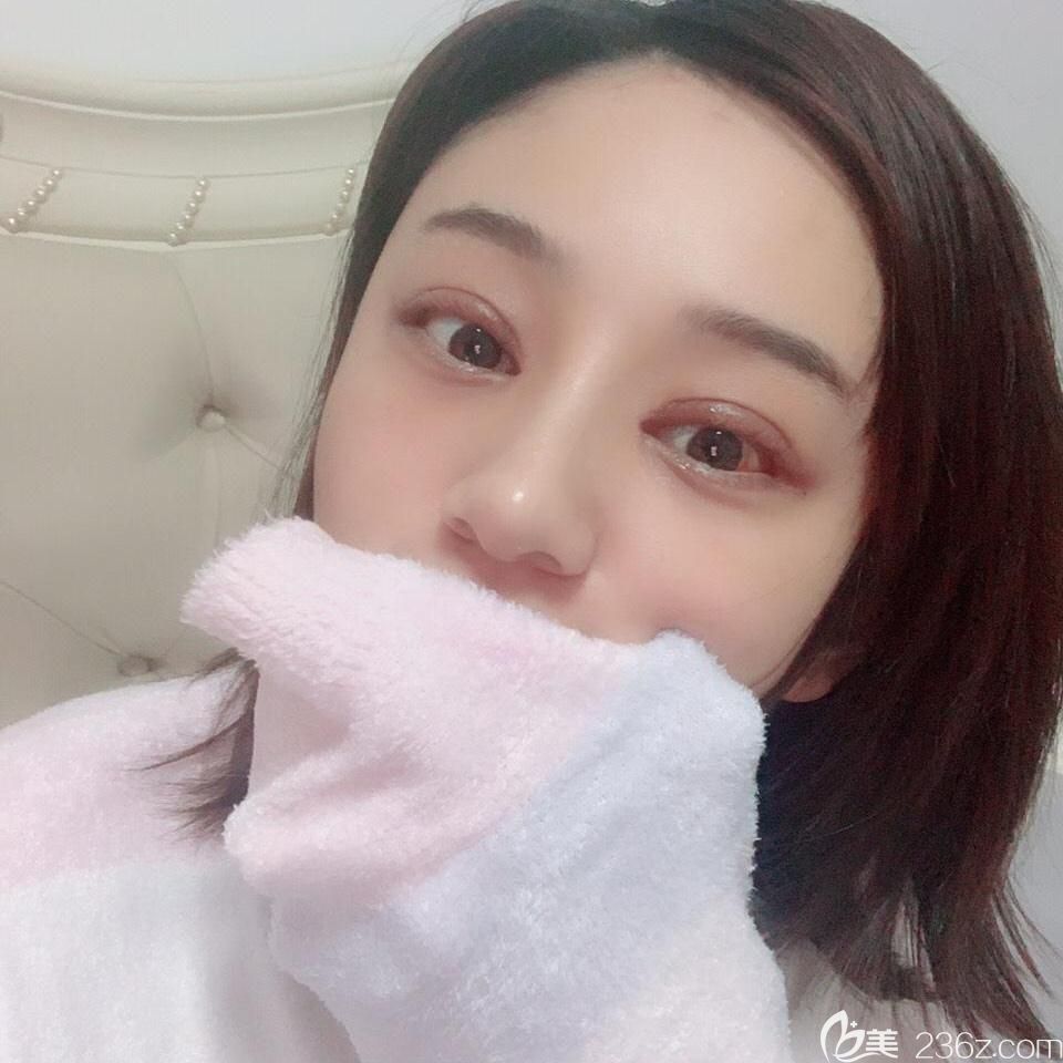 合肥白領(lǐng)安琪兒雙眼皮修復(fù)+鼻綜合術(shù)后第7天拆線后照片 合肥白領(lǐng)安琪兒雙眼皮修復(fù)+鼻綜合術(shù)后第7天拆線后照片