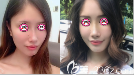 北京藝美范憲紅醫(yī)生不開刀降顴骨顴弓案例 北京藝美范憲紅醫(yī)生不開刀降顴骨顴弓案例