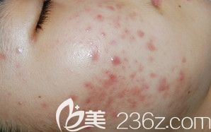 祛痘前 祛痘前