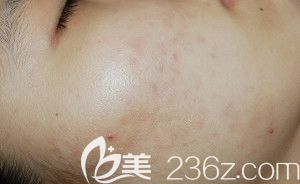 在韓國海德仁醫(yī)院算是祛痘順利，真的太不容易了